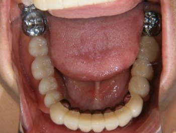 テレスコープ義歯の症例