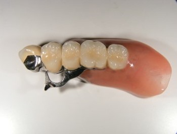 テレスコープ義歯の症例