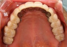 上顎リーゲルテレスコープ義歯