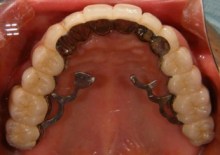 上顎リーゲルテレスコープ義歯