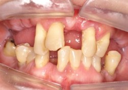 上顎精密製作式総義歯、下顎フリクションピンコーヌステレスコープ義歯で治療前