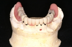 フリクションピンコーヌステレスコープ義歯