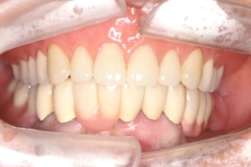 上顎精密製作式総義歯、下顎フリクションピンコーヌステレスコープ義歯で治療後