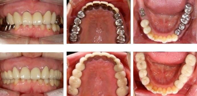 上の前歯と奥歯の銀歯をメタルセラミック・左下の奥歯２本をインプラントにて治療